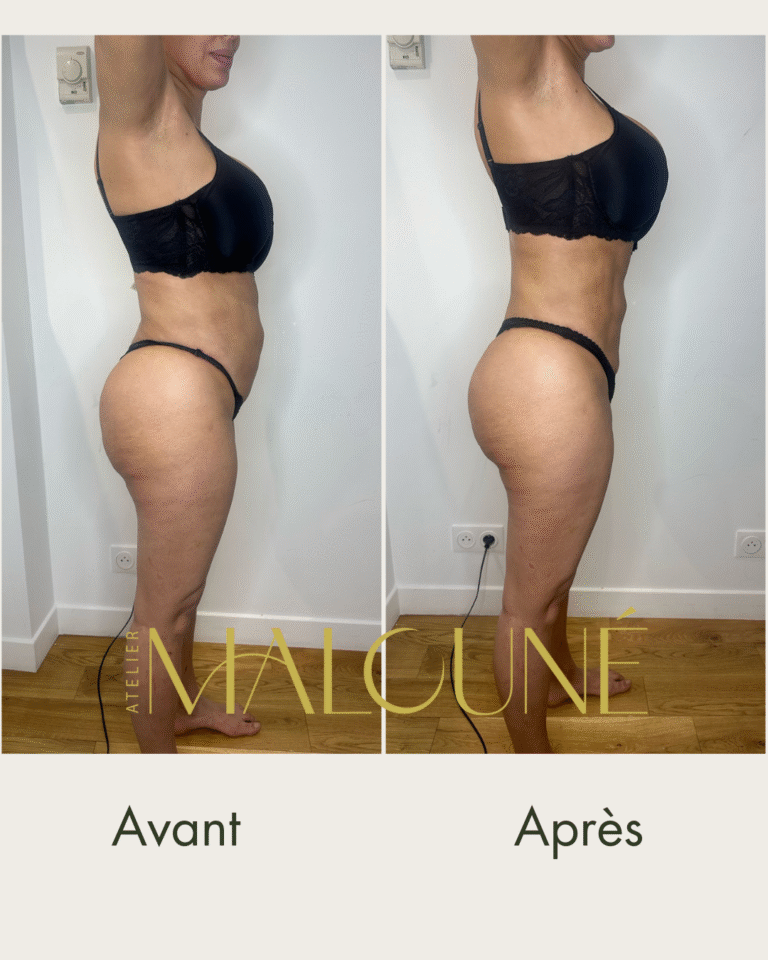 Drainage lymphatique à domicile Hauts-de-Seine – Atelier Malouné