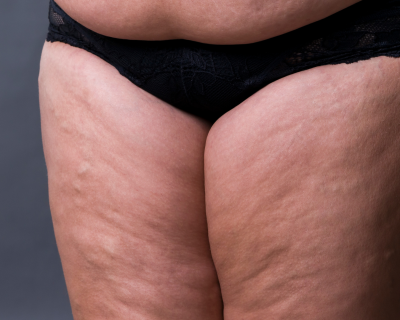 drainage-lymphatique-lipoedeme